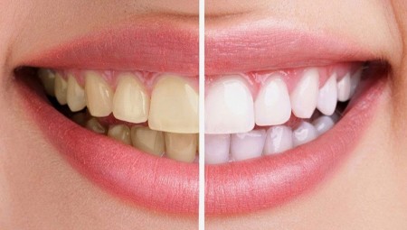 يمكن لأسنانك أن تخبرك الكثير عن صحتك..تعرّف على بعض منها