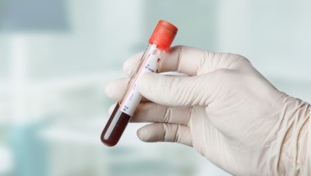 اختبار بريطاني جديد يكشف عن أكثر من 50 نوعا من السرطان بفحص الدم