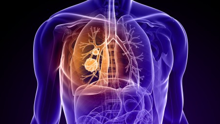 NHS تطلق برنامجا لفحص جميع المدخنين في إنجلترا للكشف المبكر عن سرطان الرئة