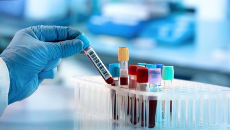 دراسة: اختبار الدم قد يشخص مرض الزهايمر قبل سنوات من ظهور الأعراض