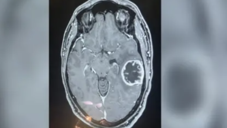 فريق طبي بريطاني يطور اختبارًا يسرّع تشخيص أورام الدماغ من أسابيع إلى ساعات