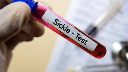 استثمار حكومي لضمان علاج أسرع وأسهل لمرضى فقر الدم المنجلي في إنجلترا