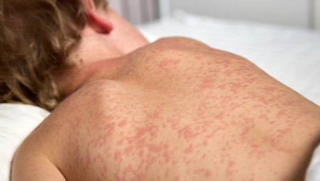 وفاة طفل في مستشفى ألدر هاي للأطفال في ليفربول بعد إصابته بالحصبة